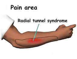 radial nerve stretch Archives - Life in a day of a Physical Therapist